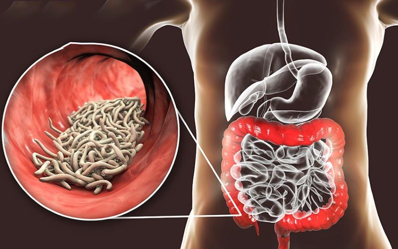 Người dùng nước phèn có nguy cơ cao bị bệnh kiết lỵ vì sunfat có trong nước